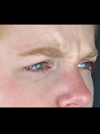 Wrinkle Relaxer Before & After Gallery - Patient 299407 - Image 1
