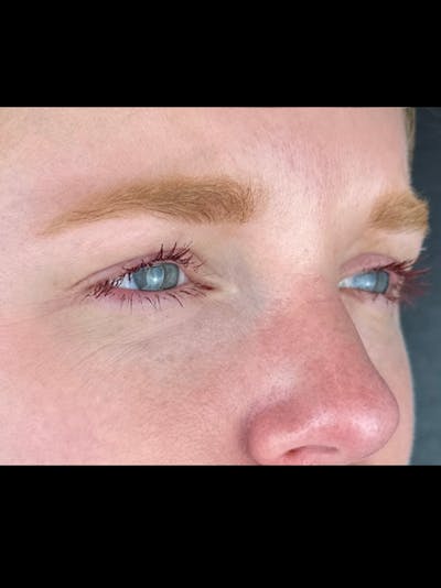 Wrinkle Relaxer Before & After Gallery - Patient 299407 - Image 2