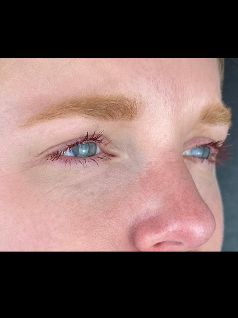 Wrinkle Relaxer Before & After Gallery - Patient 299407 - Image 2