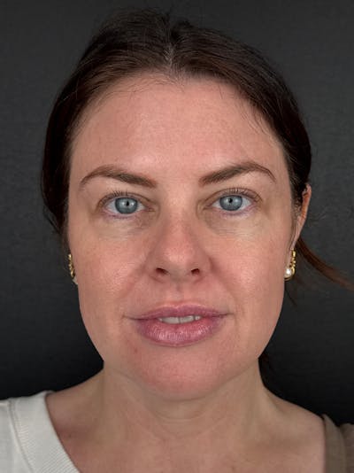 Junera Before & After Gallery - Patient 104203 - Image 1