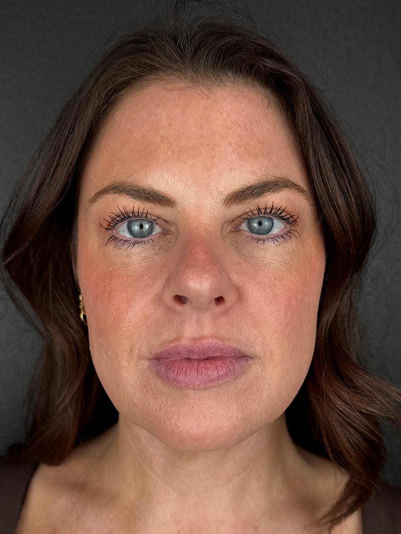 Junera Before & After Gallery - Patient 104203 - Image 2