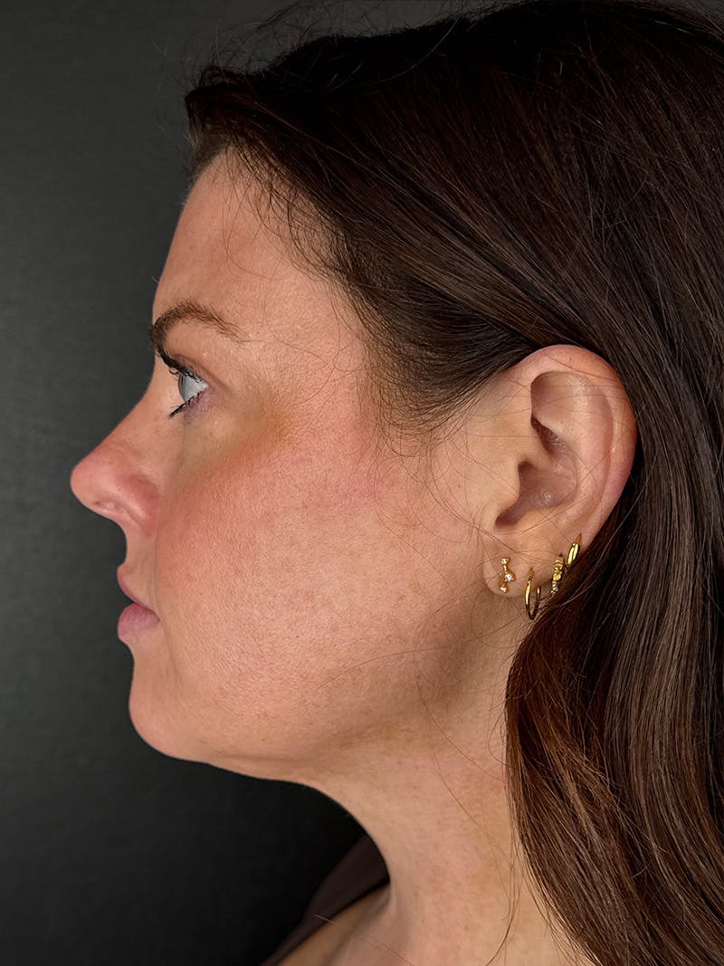 Junera Before & After Gallery - Patient 104203 - Image 4