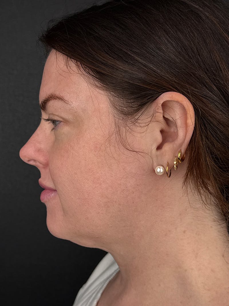 Junera Before & After Gallery - Patient 104203 - Image 3