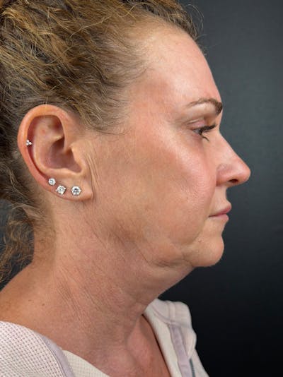Junera Before & After Gallery - Patient 968563 - Image 1