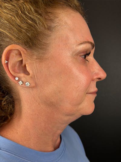Junera Before & After Gallery - Patient 968563 - Image 2