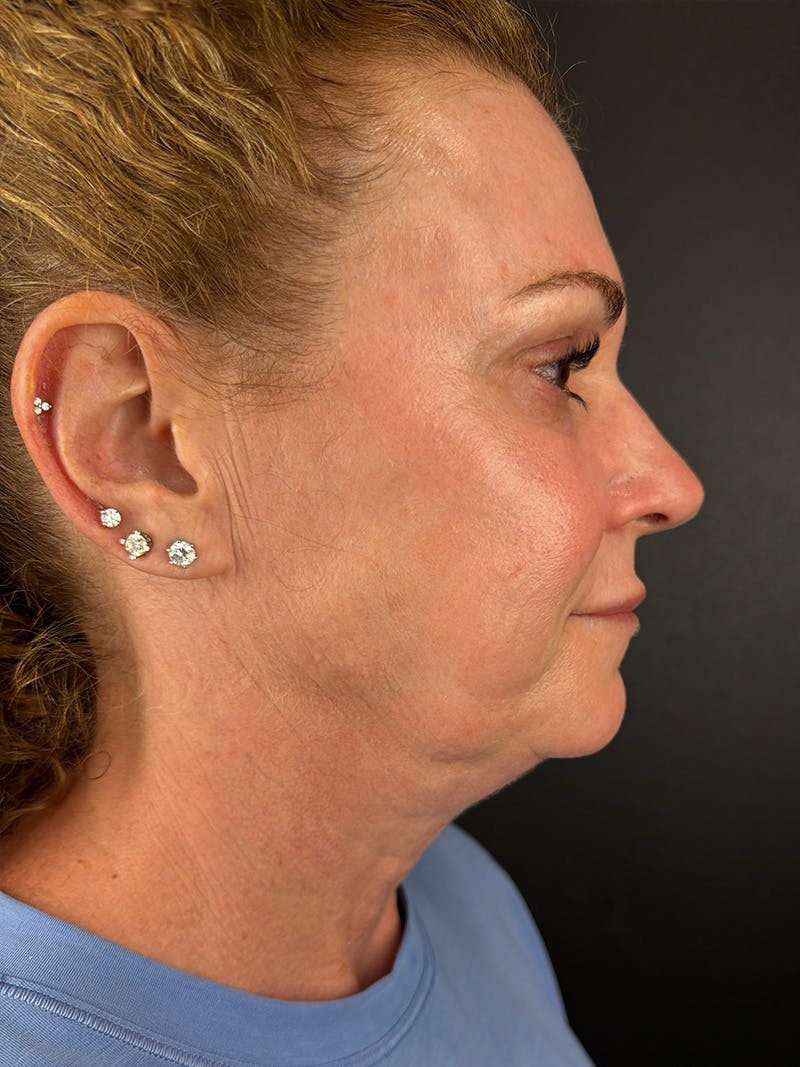 Junera Before & After Gallery - Patient 968563 - Image 2