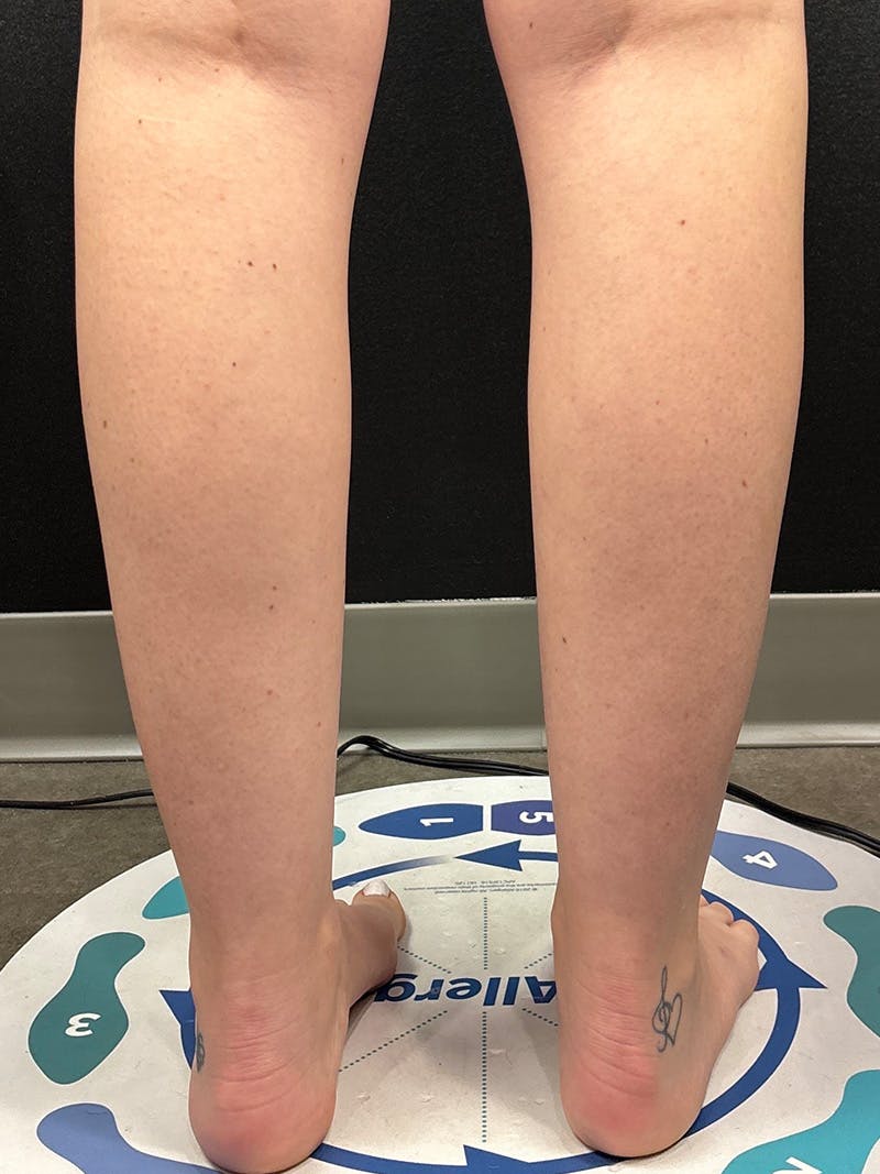 Legs (Liposuction) Before & After Gallery - Patient 483622 - Image 3