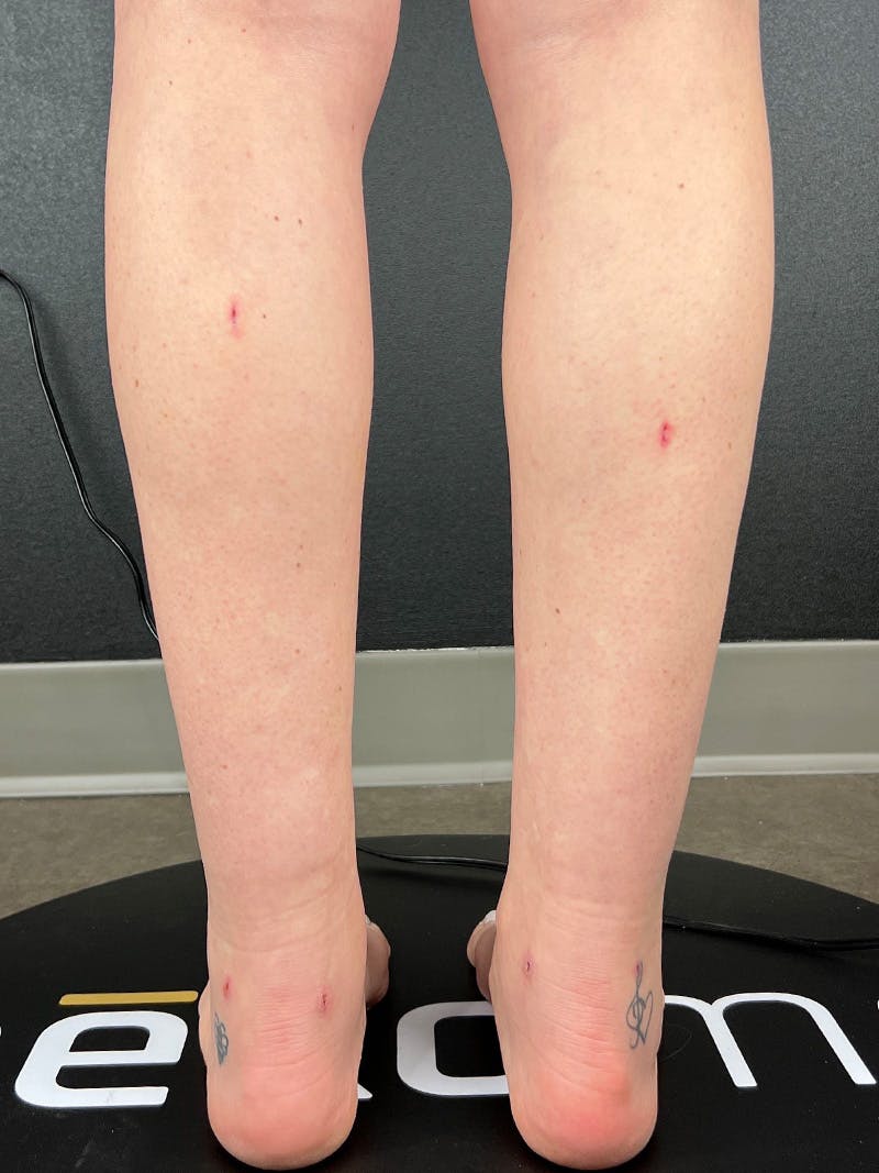 Legs (Liposuction) Before & After Gallery - Patient 483622 - Image 4