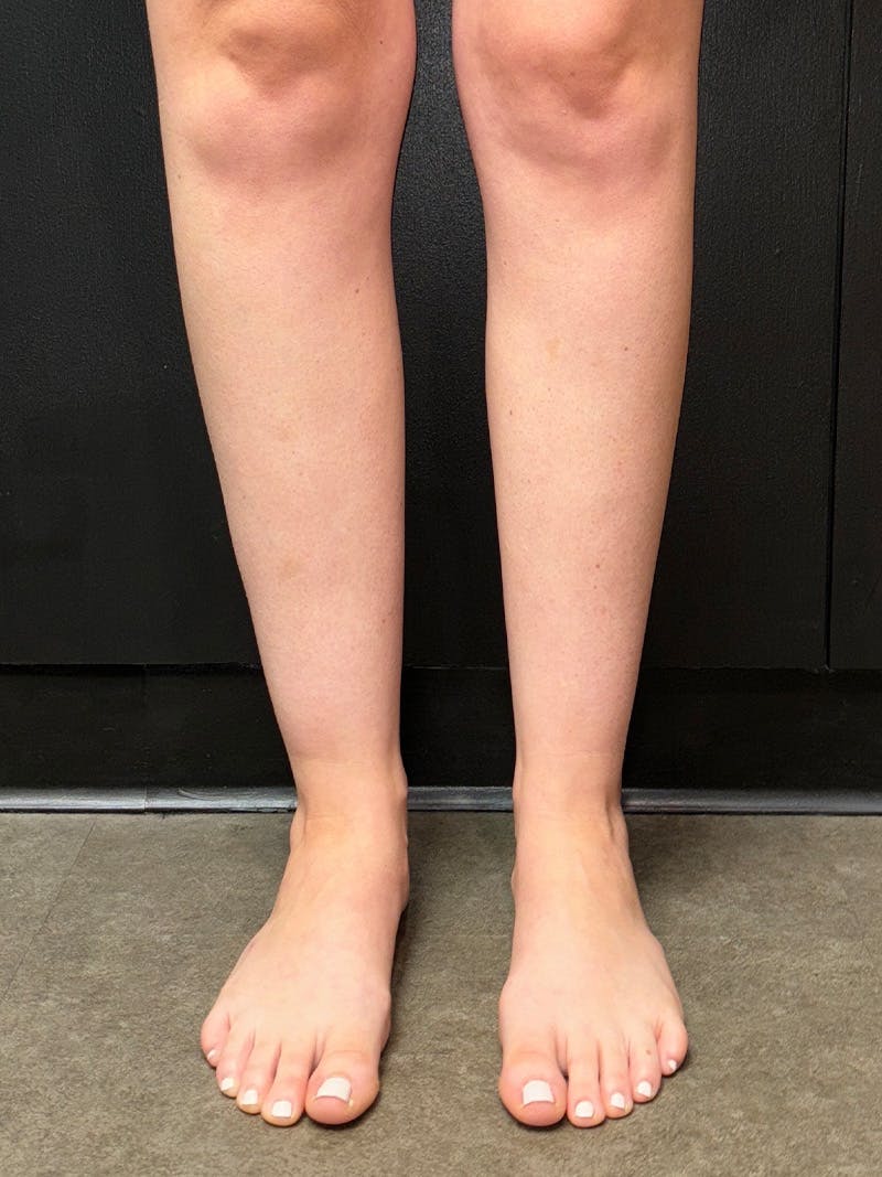 Legs (Liposuction) Before & After Gallery - Patient 483622 - Image 1