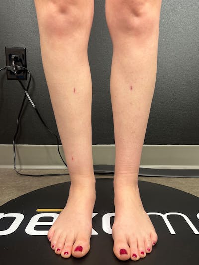 Legs (Liposuction) Before & After Gallery - Patient 483622 - Image 2