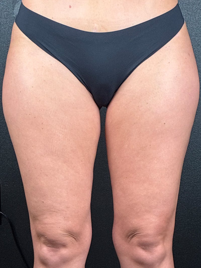 Legs (Liposuction) Before & After Gallery - Patient 143090 - Image 2