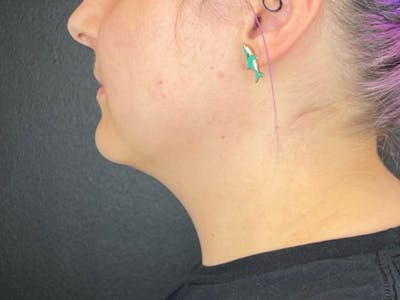  Neck/Submental Liposuction Before & After Gallery - Patient 105449 - Image 1