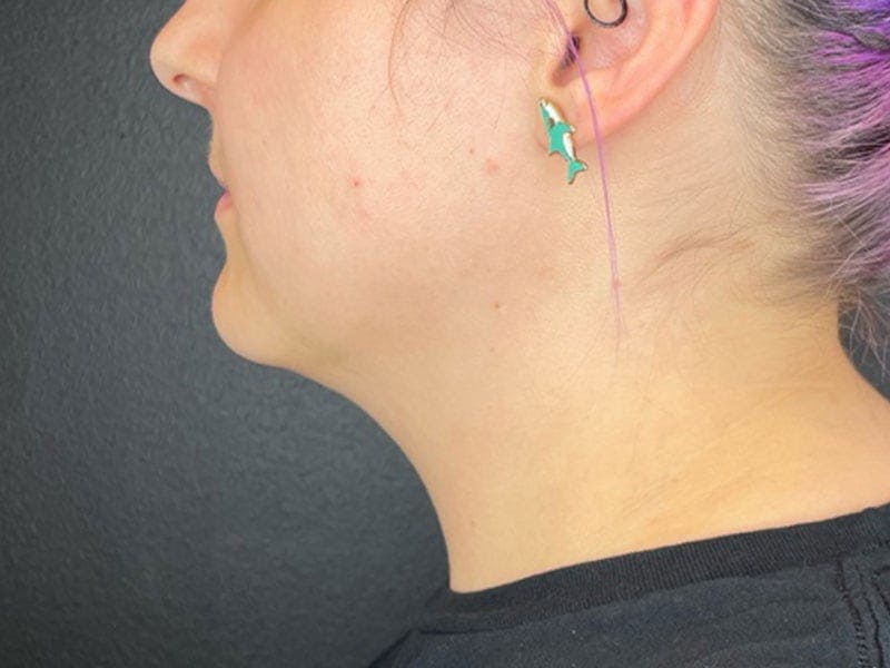 Neck/Submental Liposuction Before & After Gallery - Patient 105449 - Image 1