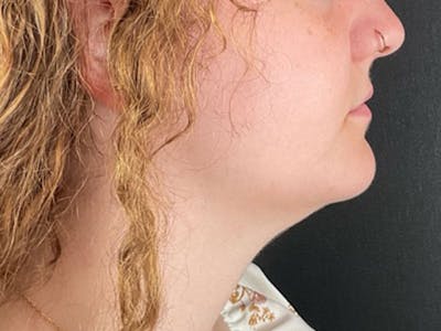  Neck/Submental Liposuction Before & After Gallery - Patient 271309 - Image 2