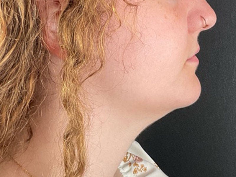  Neck/Submental Liposuction Before & After Gallery - Patient 271309 - Image 2