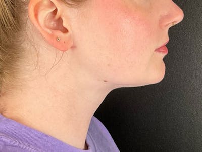  Neck/Submental Liposuction Before & After Gallery - Patient 171962 - Image 2