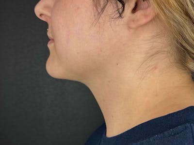  Neck/Submental Liposuction Before & After Gallery - Patient 105449 - Image 2