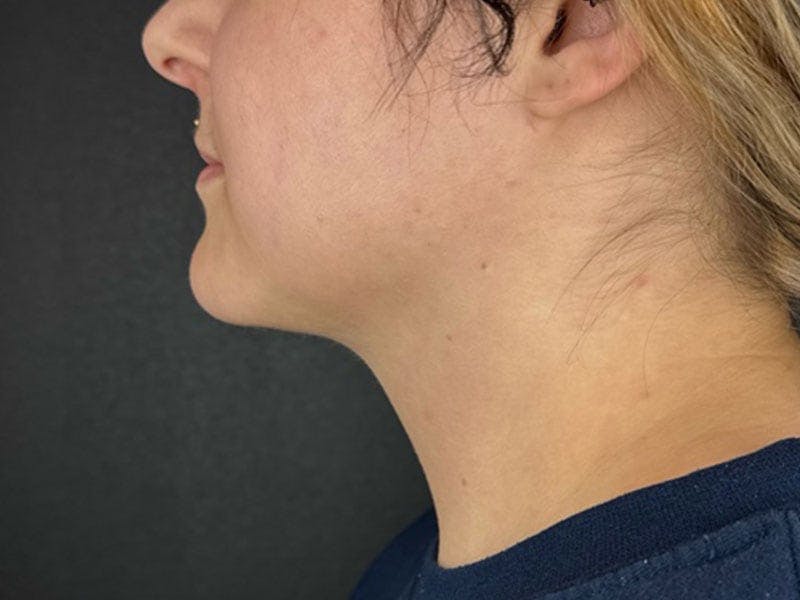  Neck/Submental Liposuction Before & After Gallery - Patient 105449 - Image 2
