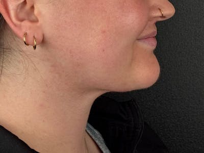  Neck/Submental Liposuction Before & After Gallery - Patient 334164 - Image 2