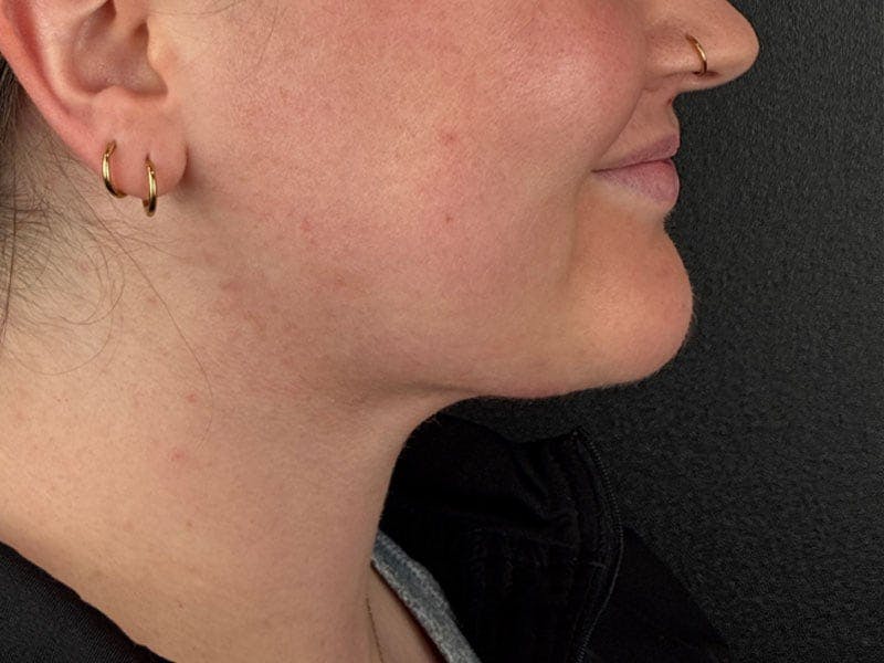  Neck/Submental Liposuction Before & After Gallery - Patient 334164 - Image 2
