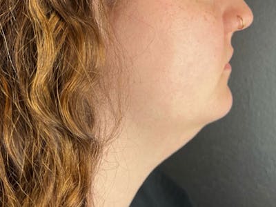  Neck/Submental Liposuction Before & After Gallery - Patient 271309 - Image 1