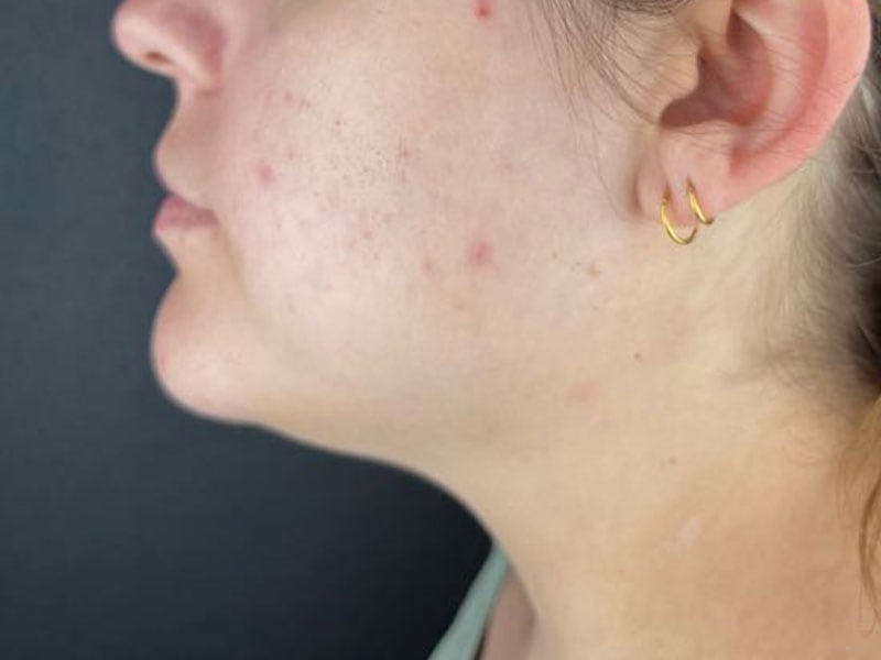  Neck/Submental Liposuction Before & After Gallery - Patient 227190 - Image 1