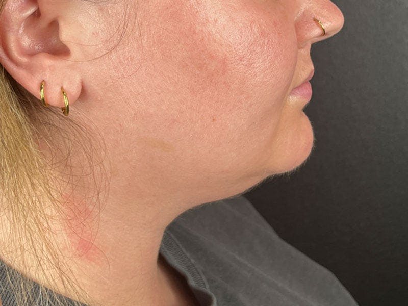  Neck/Submental Liposuction Before & After Gallery - Patient 334164 - Image 1