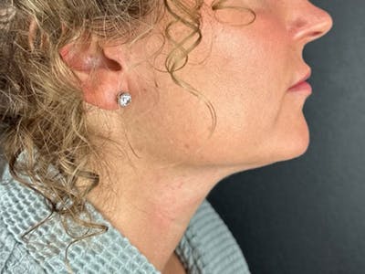  Neck/Submental Liposuction Before & After Gallery - Patient 409630 - Image 1