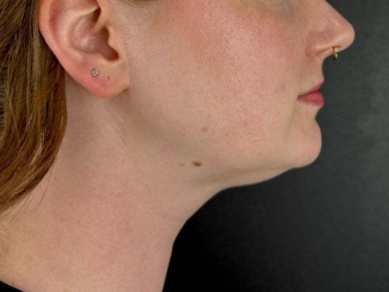  Neck/Submental Liposuction Before & After Gallery - Patient 171962 - Image 1