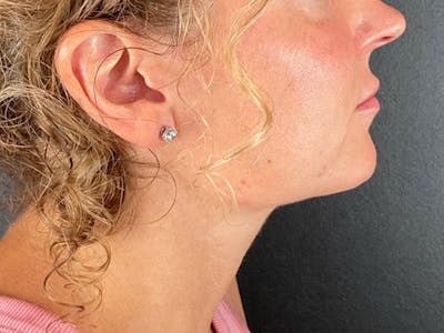  Neck/Submental Liposuction Before & After Gallery - Patient 409630 - Image 2