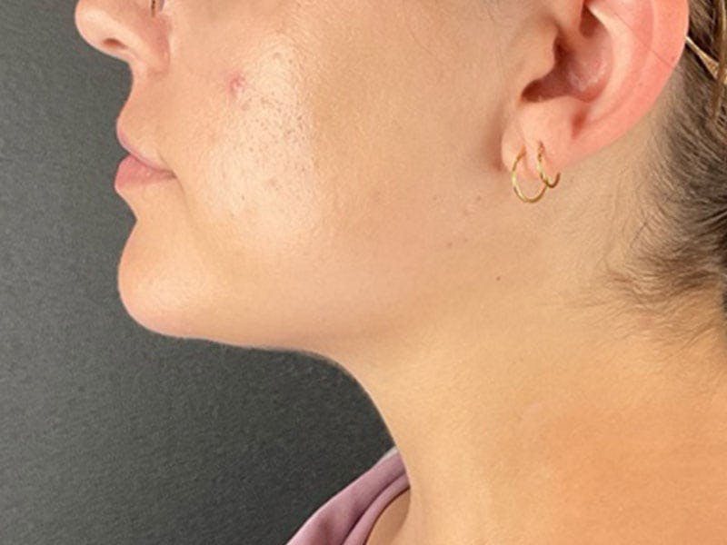  Neck/Submental Liposuction Before & After Gallery - Patient 227190 - Image 2