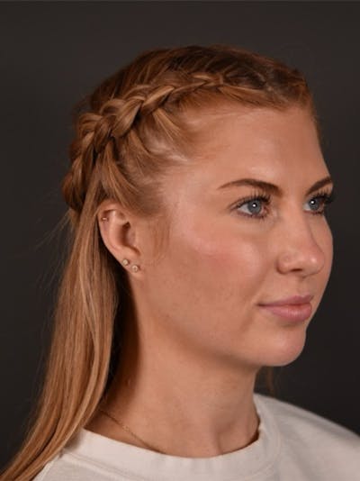 FaceTite Before & After Gallery - Patient 123857 - Image 1