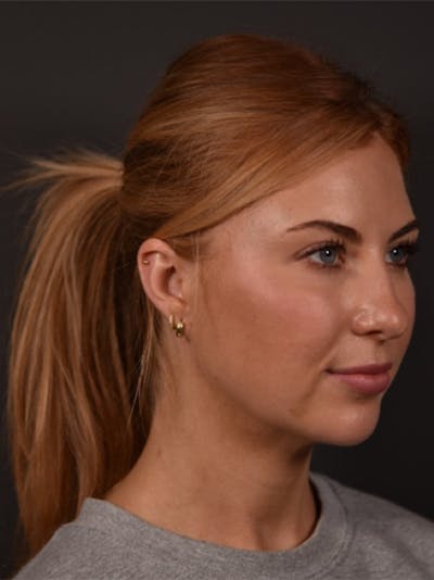 FaceTite Before & After Gallery - Patient 123857 - Image 2