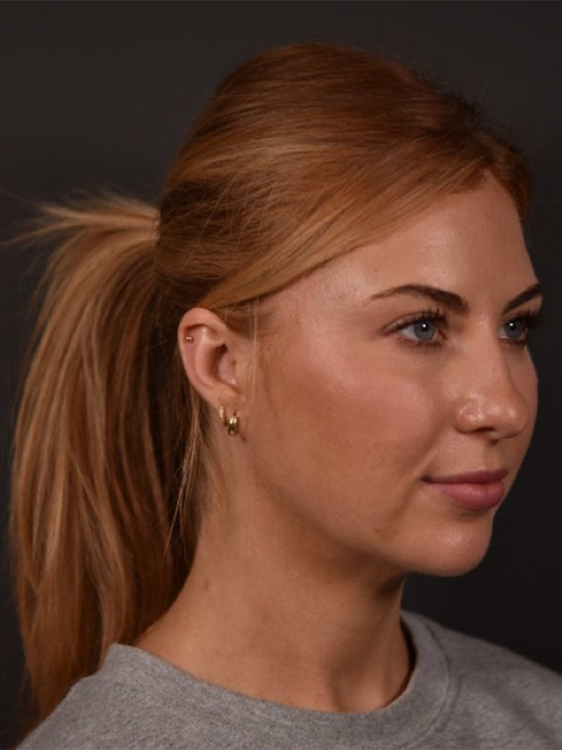 FaceTite Before & After Gallery - Patient 123857 - Image 2