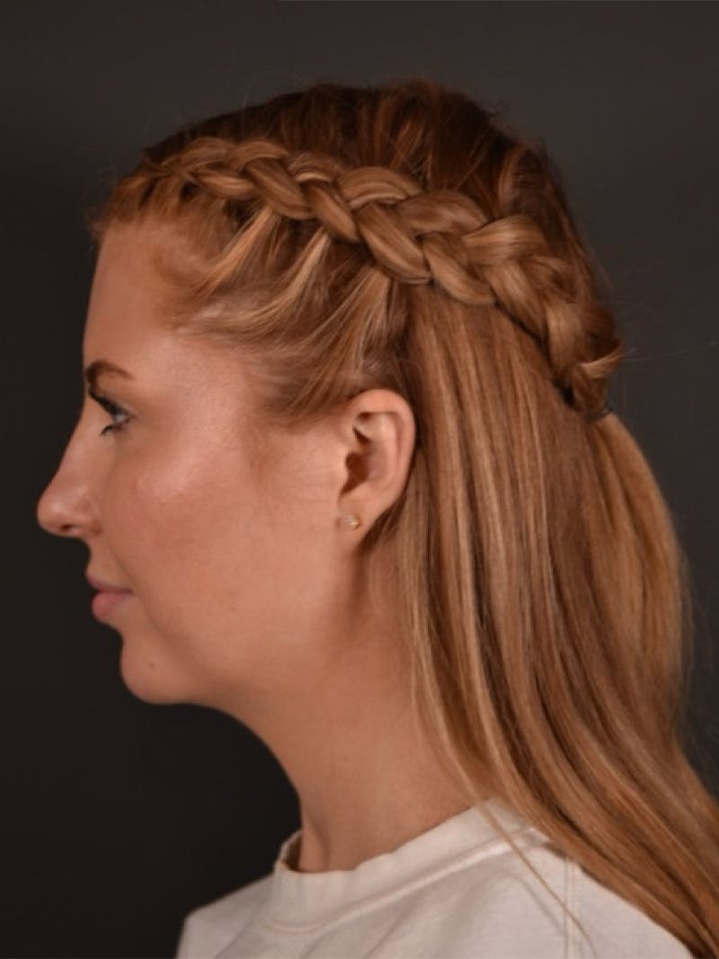 FaceTite Before & After Gallery - Patient 123857 - Image 3