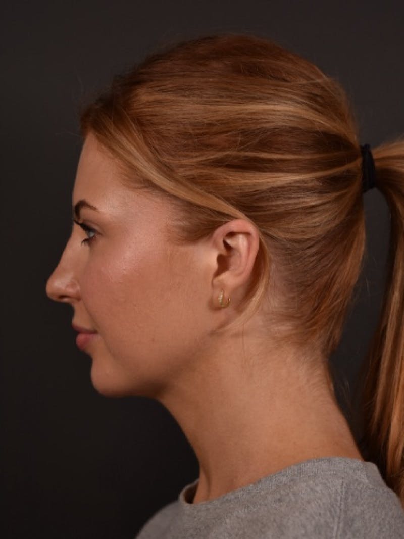 FaceTite Before & After Gallery - Patient 123857 - Image 4