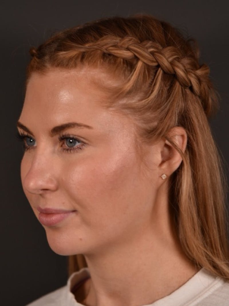 FaceTite Before & After Gallery - Patient 123857 - Image 5