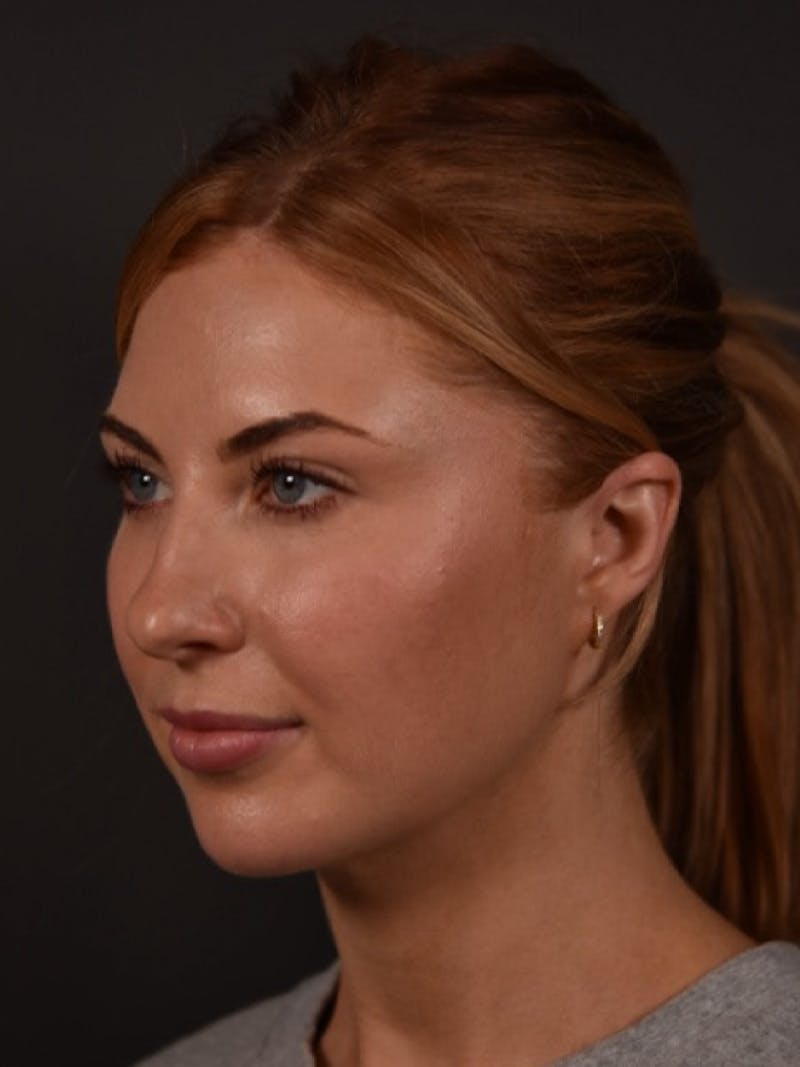 FaceTite Before & After Gallery - Patient 123857 - Image 6