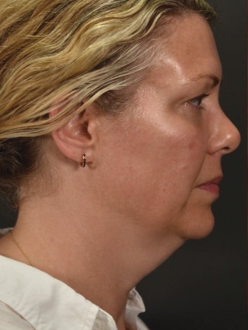 FaceTite Before & After Gallery - Patient 161237 - Image 3