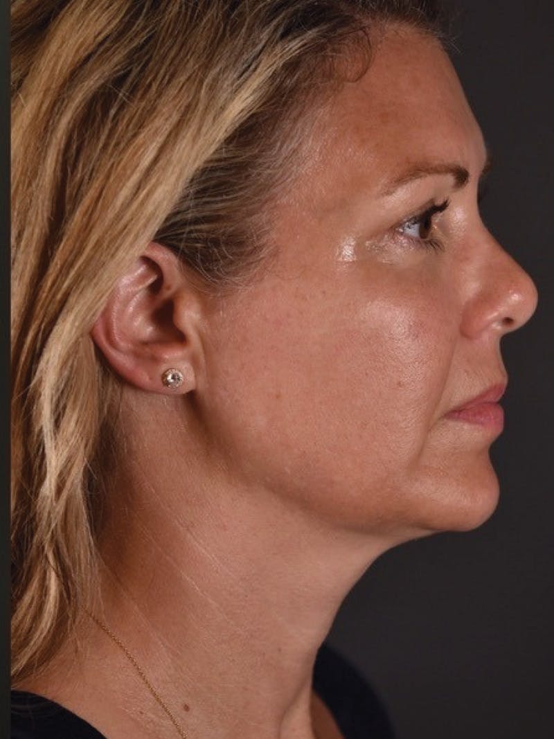 FaceTite Before & After Gallery - Patient 161237 - Image 4