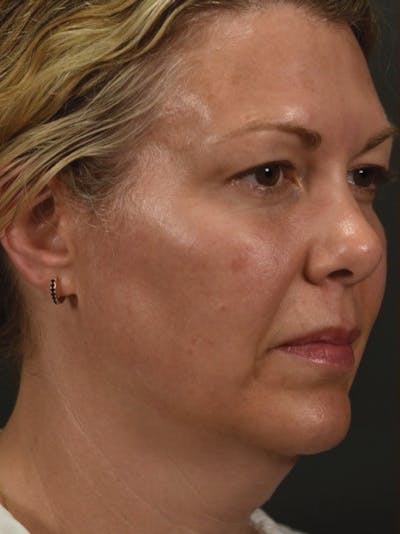 FaceTite Before & After Gallery - Patient 161237 - Image 1