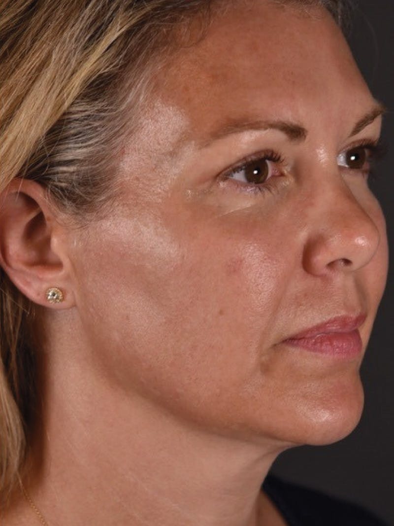 FaceTite Before & After Gallery - Patient 161237 - Image 2