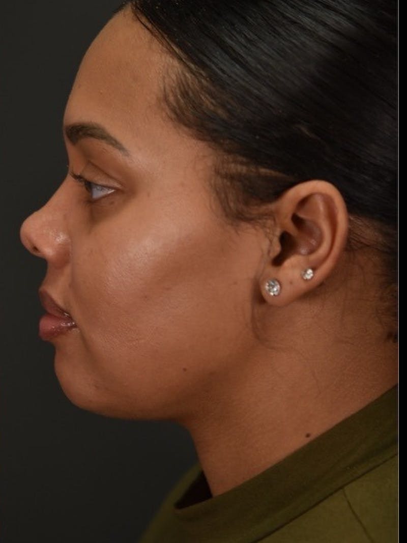 FaceTite Before & After Gallery - Patient 389313 - Image 4