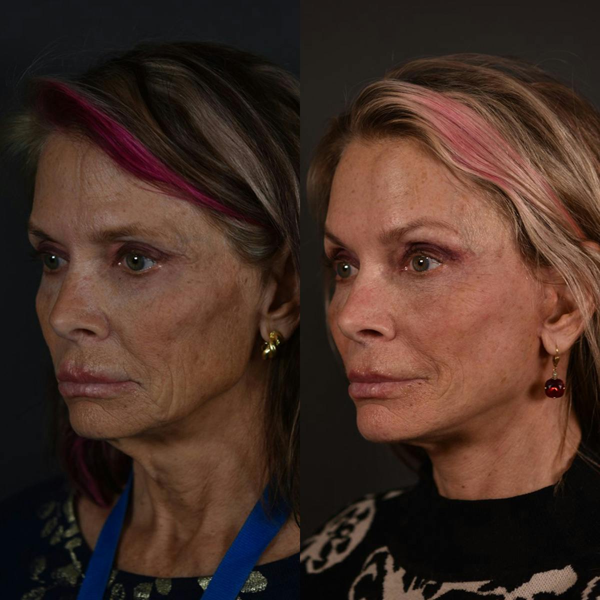 Brow Lift Before & After Gallery - Patient 767534 - Image 1