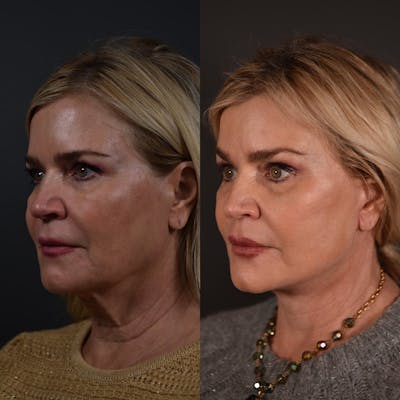 Brow Lift Before & After Gallery - Patient 257851 - Image 1