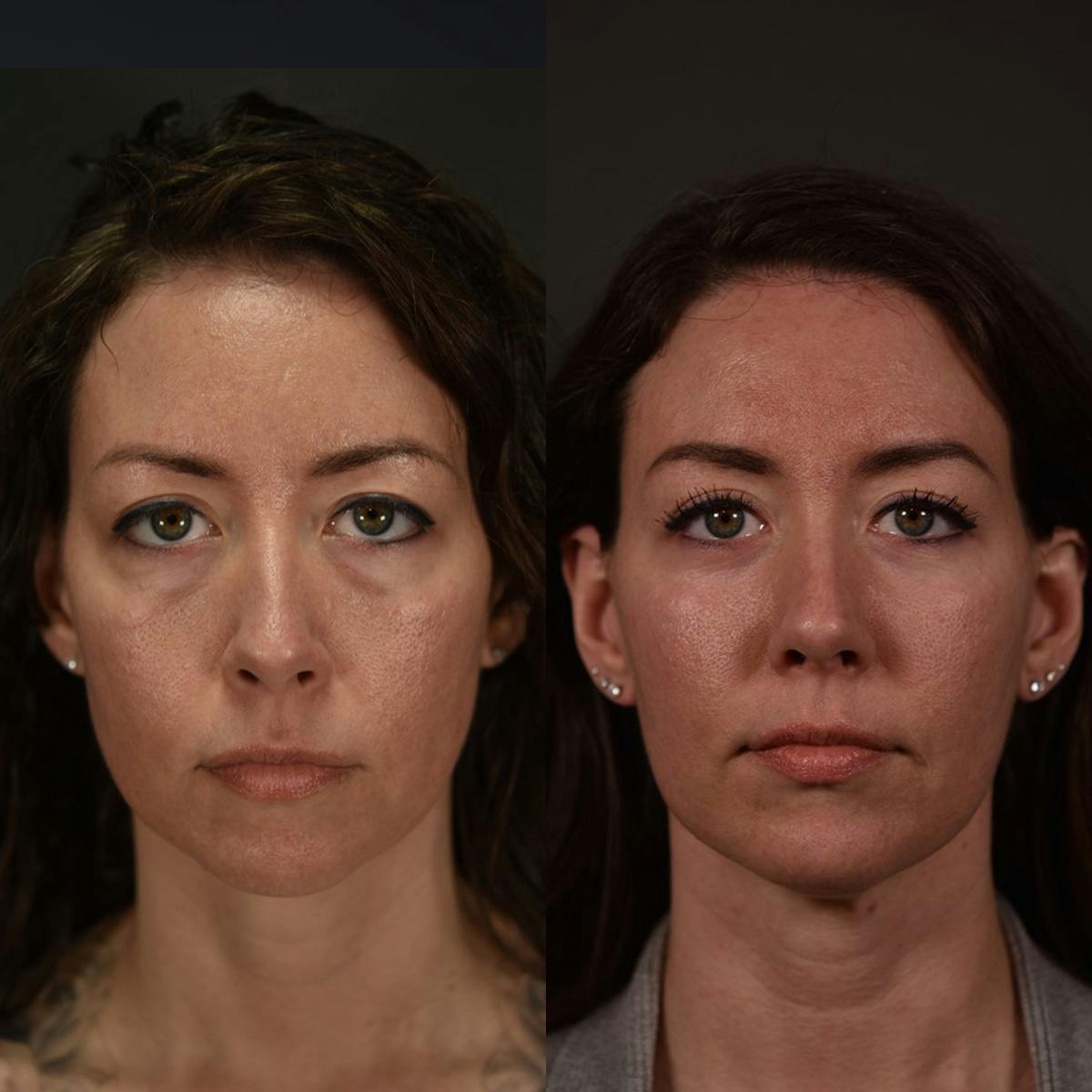 Fat Grafting Before & After Gallery - Patient 274303 - Image 1