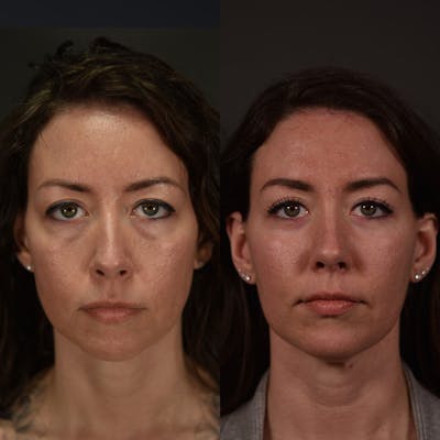 Fat Grafting Before & After Gallery - Patient 274303 - Image 1