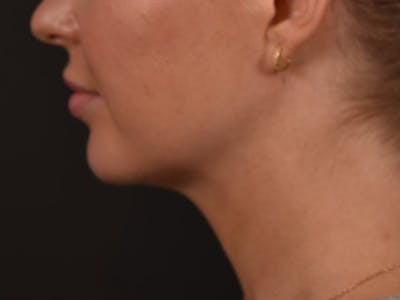  Neck/Submental Liposuction Before & After Gallery - Patient 108763 - Image 2