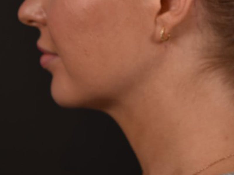 Neck/Submental Liposuction Before & After Gallery - Patient 108763 - Image 2