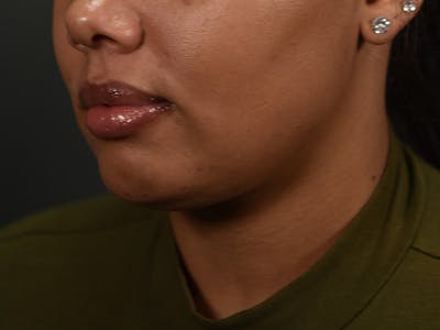  Neck/Submental Liposuction Before & After Gallery - Patient 285287 - Image 2